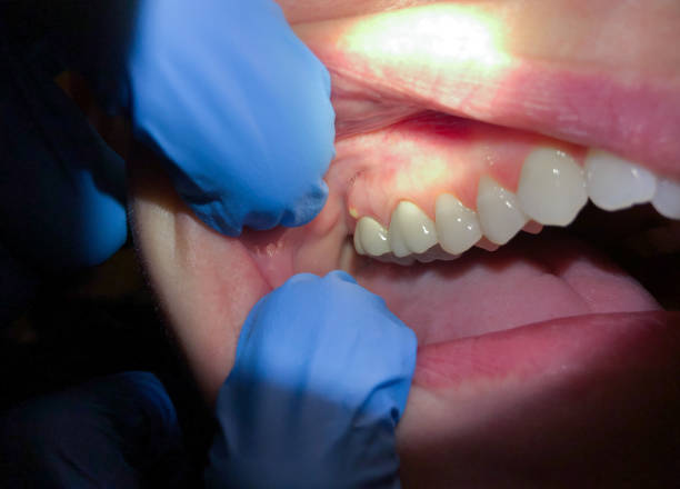 Best Emergency Treatment for Dental Infections or Abscesses in Elverta, CA